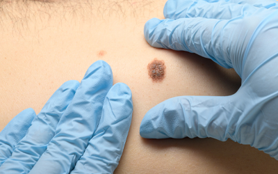Gloved hands examining a mole on a person's back (c) UC Regents. All rights reserved.