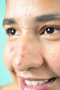 Acne on a teenager's face (c) UC Regents. All rights reserved.