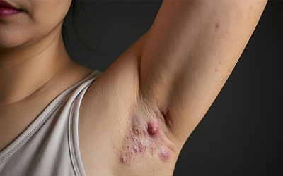 Underarm skin condition (c) UC Regents. All rights reserved.