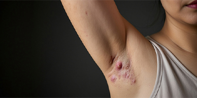 Underarm view of hidradenitis suppurativa (c) UC Regents. All rights reserved.