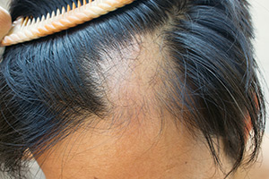 Hair disorders