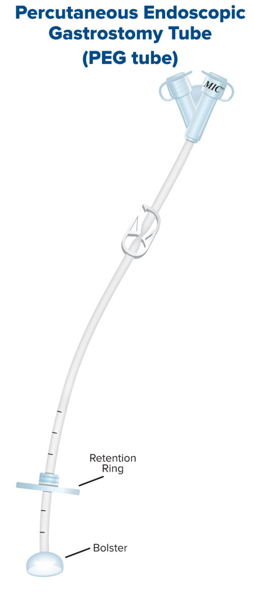 Percutaneous Endoscopic Gastrostomy Tube (PEG tube)