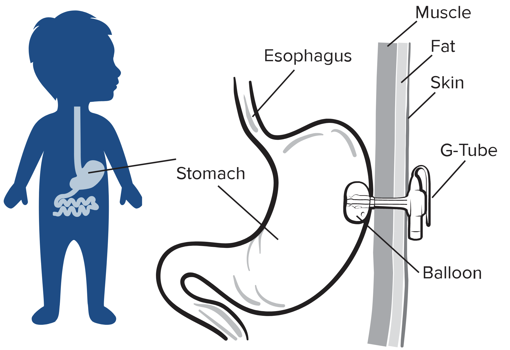 baby with tube illustration