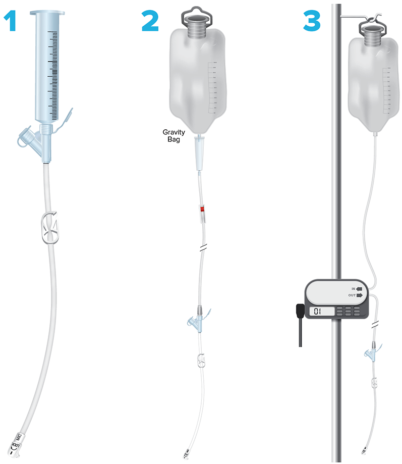 three ways that tube feedings