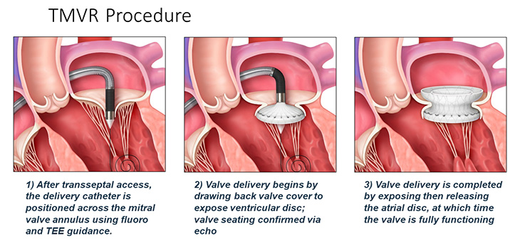 Three pictures showing how TMVR procedure is done