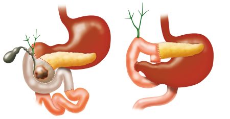 Illustration of Whipple procedure.