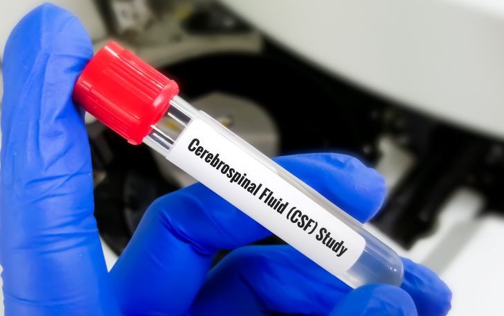 A gloved hand holds a test tube with a red top with the words “Cerebrospinal Fluid.”