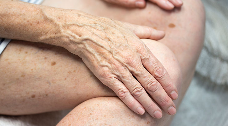 woman's hands and legs with some age spots and how you can get rid of age spots