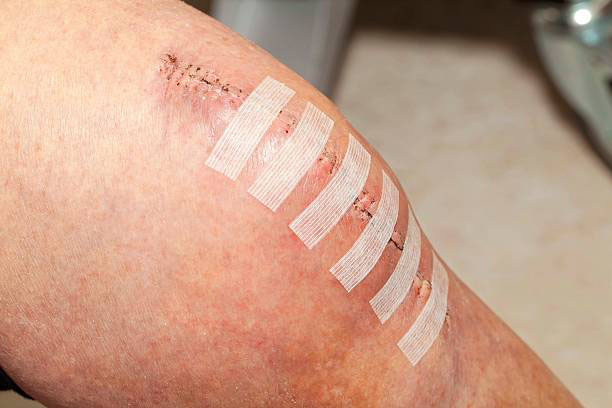 Photo of knee with incision held together with strips