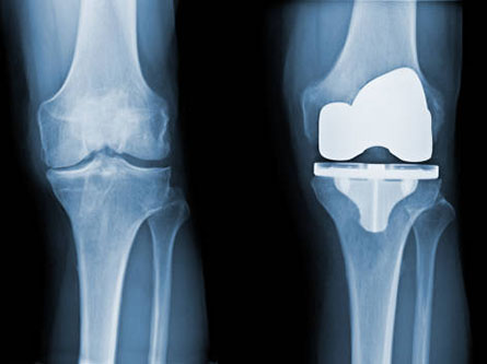 image of knee xray