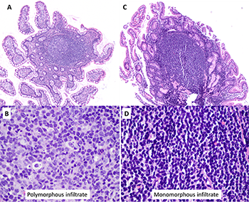 Reactive versus neoplastic lymphoid aggregates