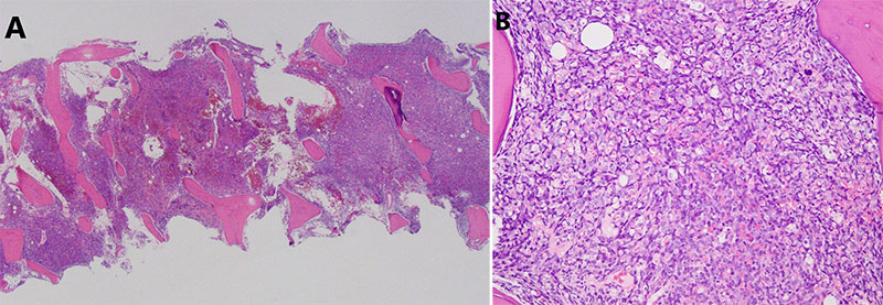 Bone marrow trephine biopsy