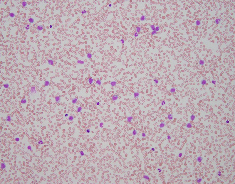 Peripheral blood smear