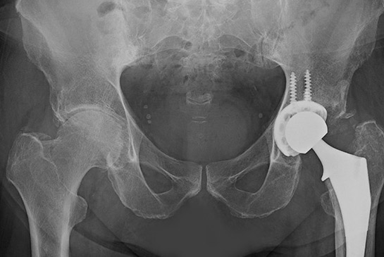 Hip xray