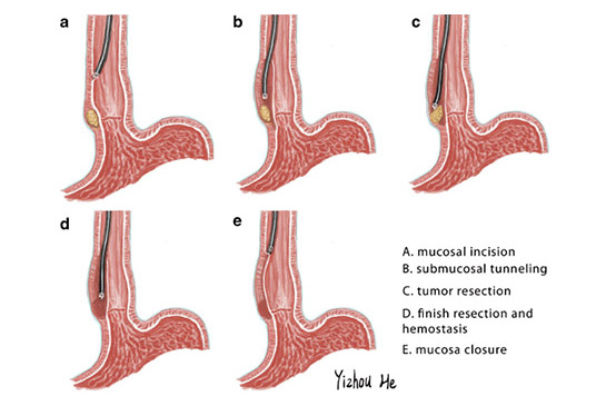 Scientific graphic of endoscopic procedure 
