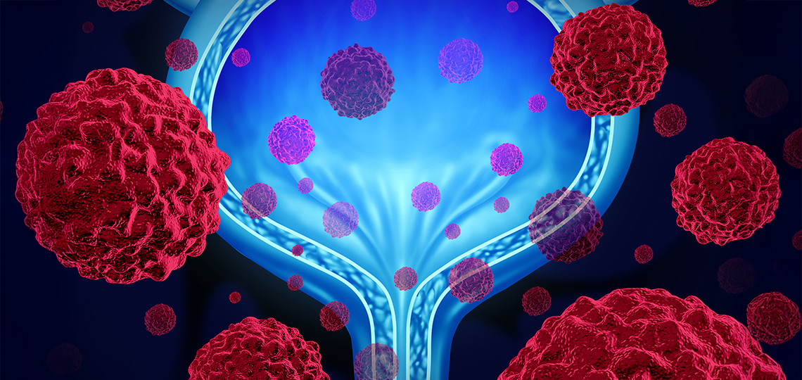 Bladder cancer clinical  trial is region’s first
