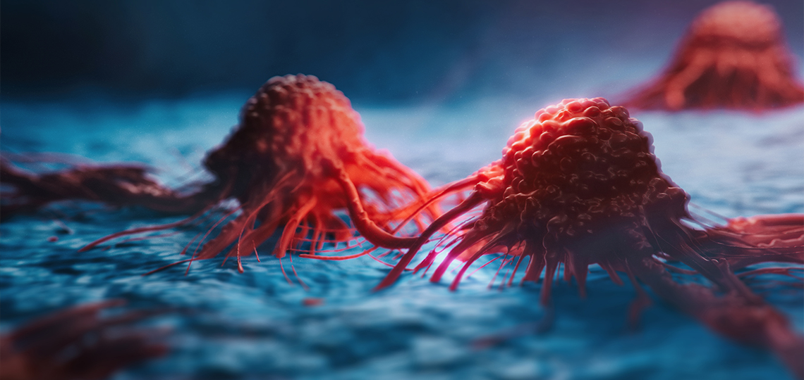 Clinical trial shows  biomarkers hold clue  in treating aggressive  prostate cancer