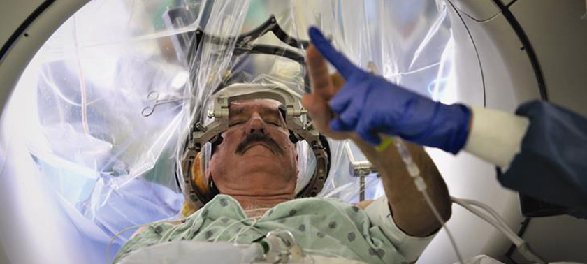 Patient undergoing functional deep brain stimulation surgery