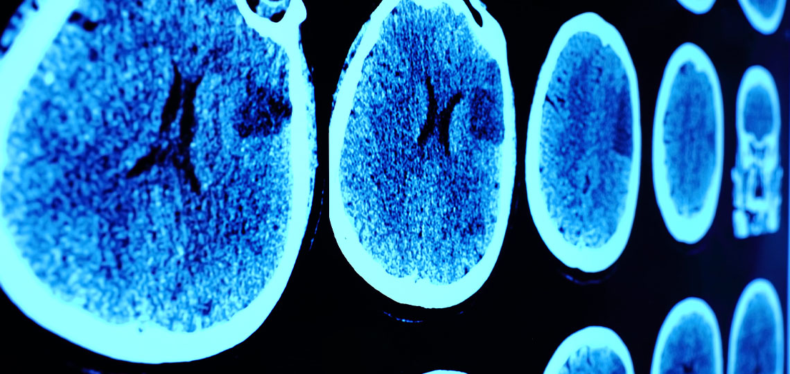 Skull CT Scan