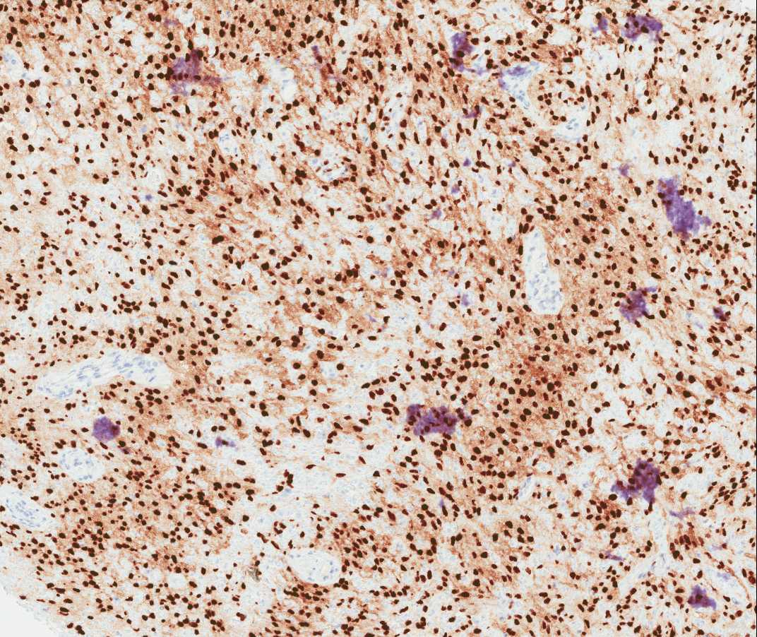 Case of the Month, Aug. 2012: Microscopic images - Figure 7