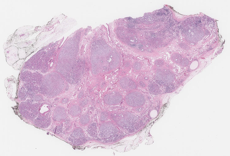 Figure 1. Disorganized architecture is present, kidney lacks usual collecting system (H&E, 2x)