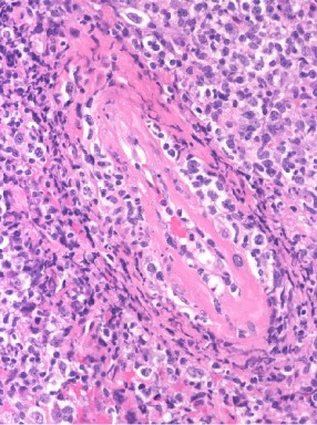 Presence of angioinvasion by various sized lymphoid infiltrates