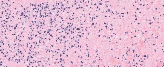 In situ hybridization for Epstein-Barr virus small-encoded RNA (EBER)