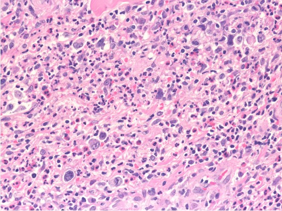 Ulcer base