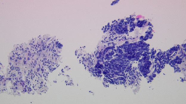 Previous lung biopsy 200x