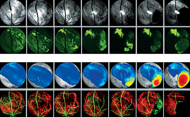 These images show glioblastoma cells growing under the retina of a mouse eye using two different kinds of optical scanning technologies. The first and second rows show reflected and fluorescent light. In the third row tumor thickness is color coded, with red representing the greatest thickness. The fourth row images blood vessels, with green showing the anterior retinal vessels and the red the posterior choroidal vessels.