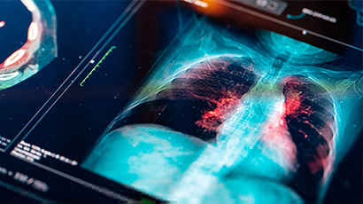 Exploring barriers to lung cancer screening