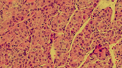 Microbiome impact on sarcoma immunotherapy