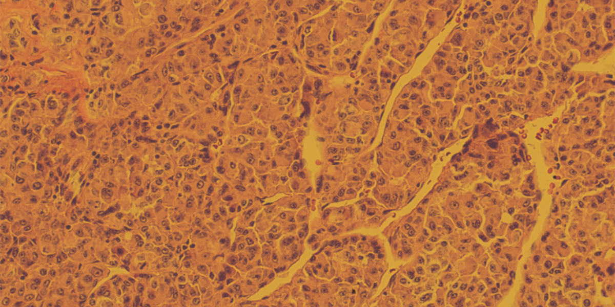 sarcoma-patients